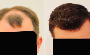Front before and after FUE surgery