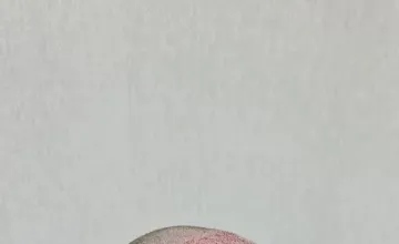 Side View Graft Placement 
