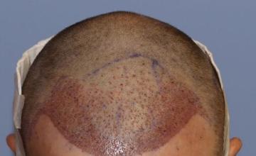 Graft Placement