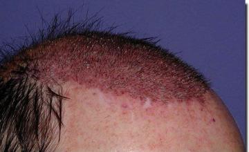 Hair restoration procedure results