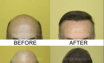 Before and After