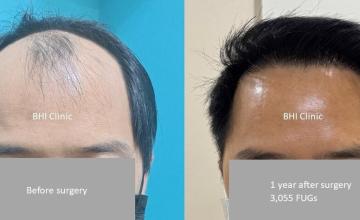 Frontal Before and After 