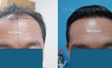 Frontal Before and After 