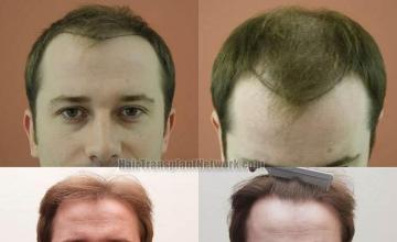 Hair transplantation surgery before and after pictures